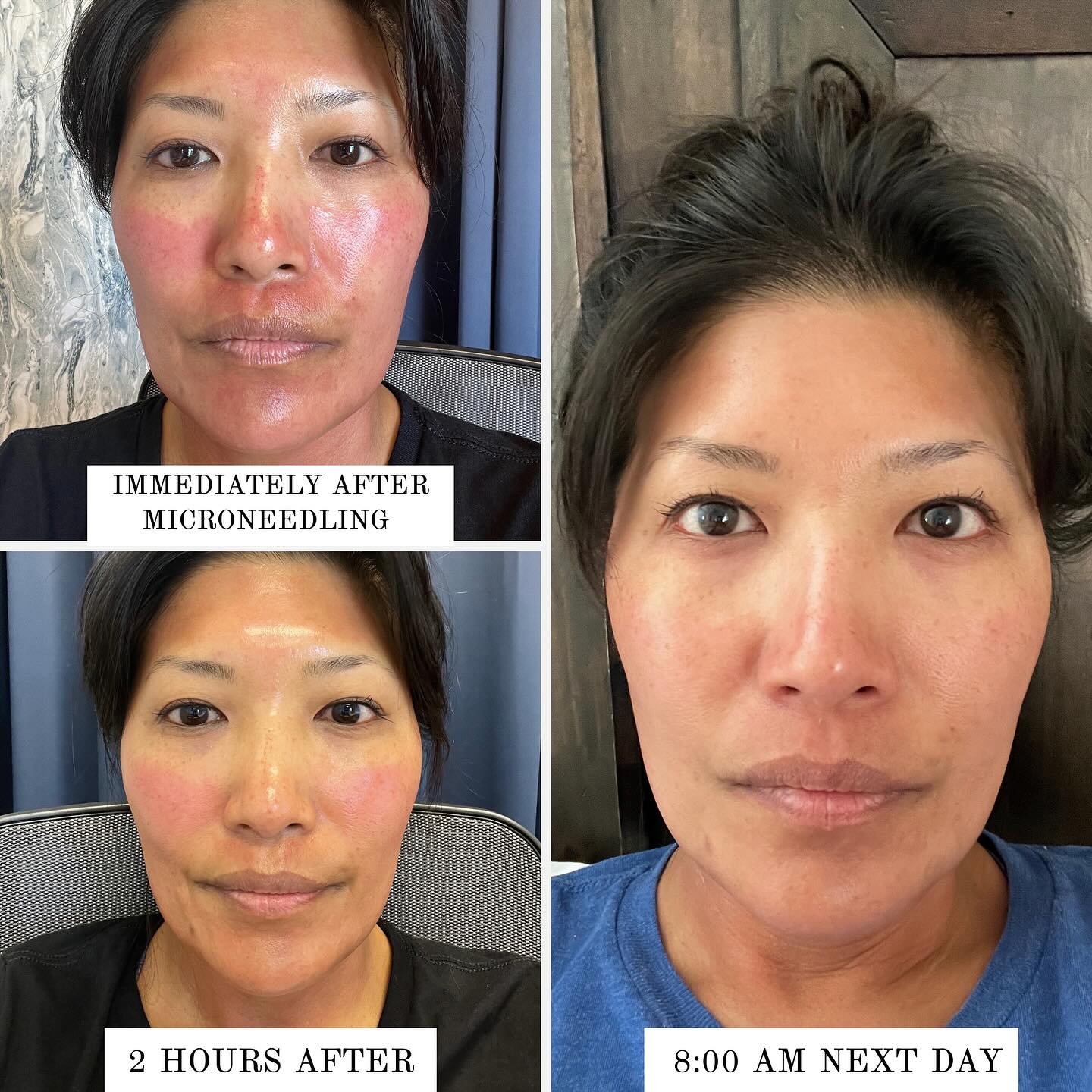 Microneedling